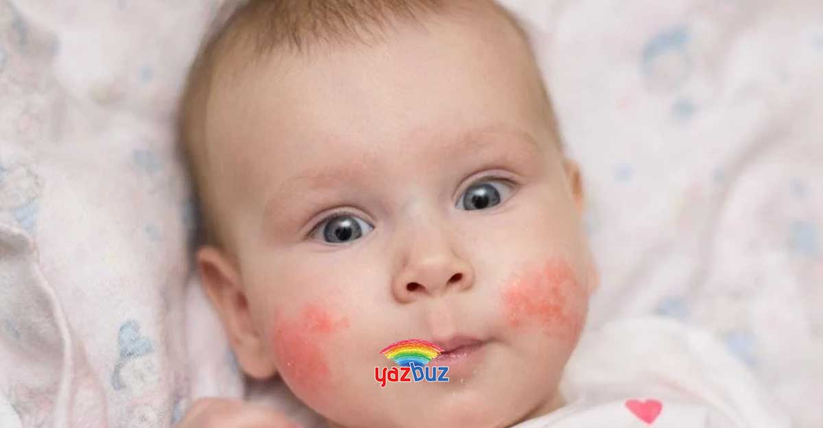 Bebeklerde Vücutta Kırmızı Lekeler Neden Olur? Tehlikeli mi?